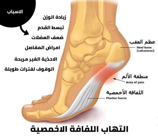 أفضل الأحذية لعلاج اللفافة الأخمصية والفلات فوت